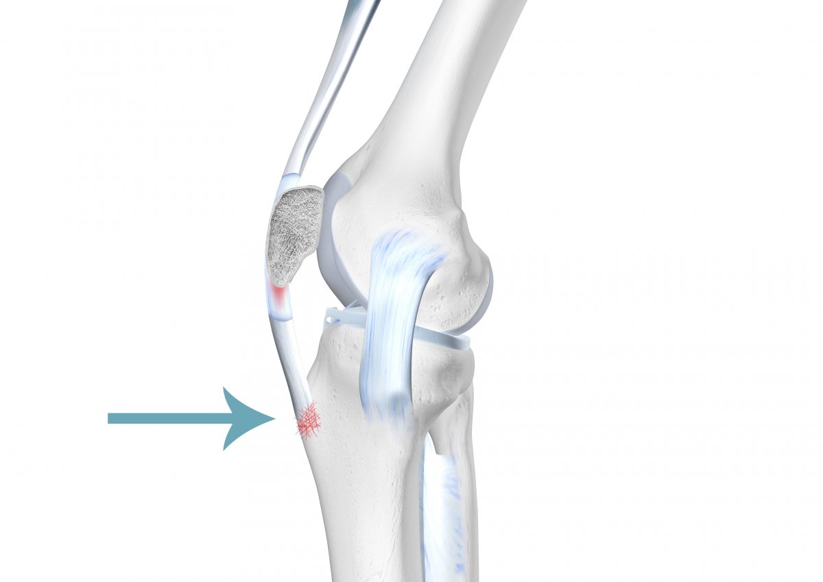 ᐅ morbus osgood schlatter op, morbus osgood schlatter operation ...